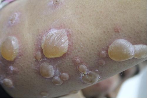 Large blisters on arm before treatment