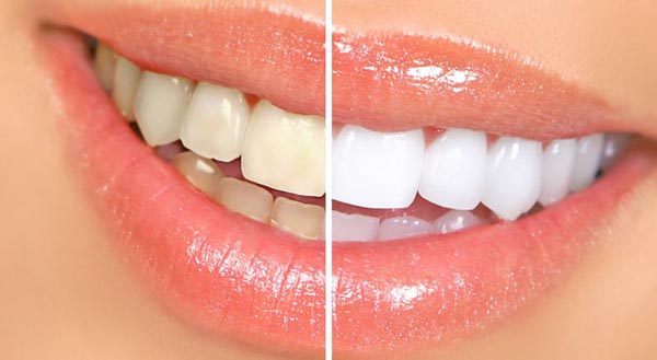 Home-Remedies-for-Whiter-Teeth